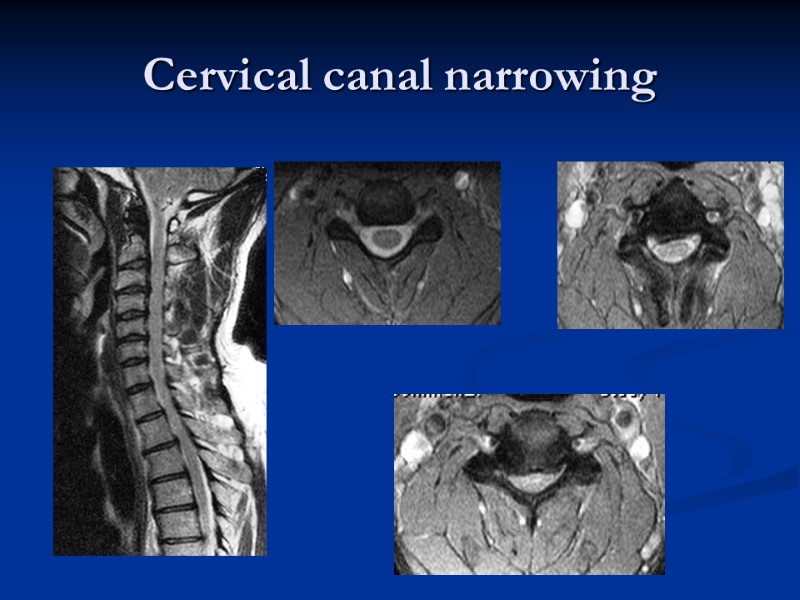 Cervical canal narrowing